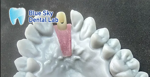 Zirconia Abutment