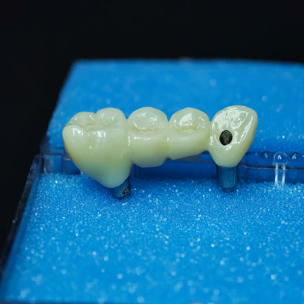 Zirconia Bridge With Screw Retained