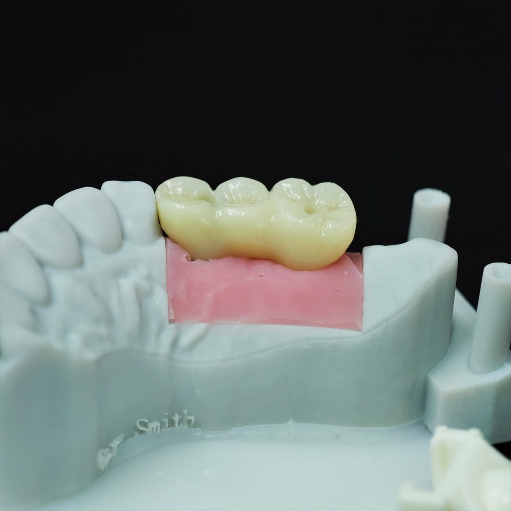 Zirconia Bridge With Screw Retained
