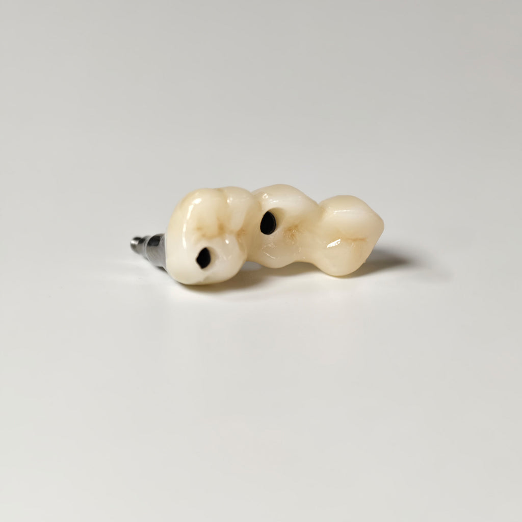 Zirconia Bridgewith Screw Retained
