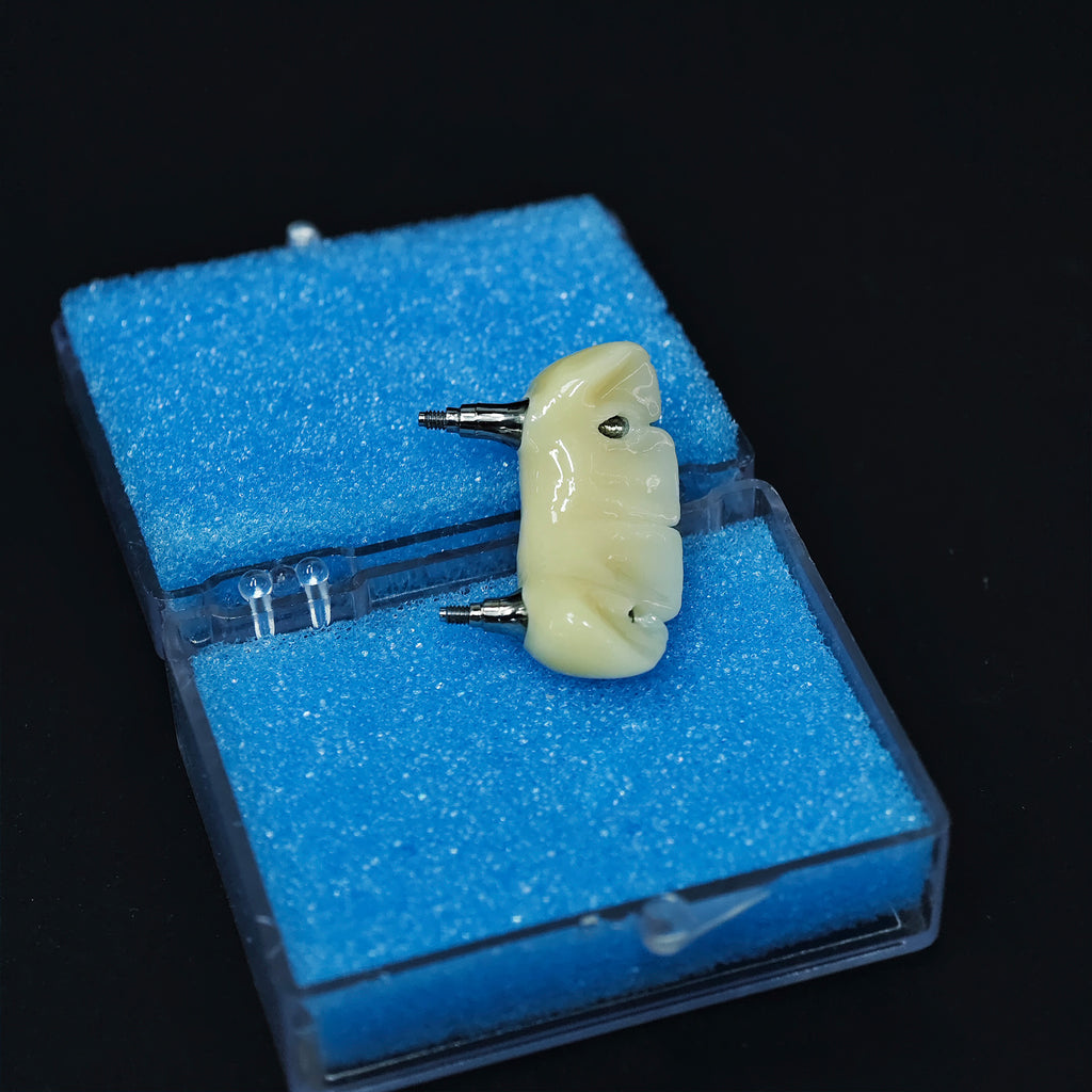 Zirconia Bridge With Screw Retained