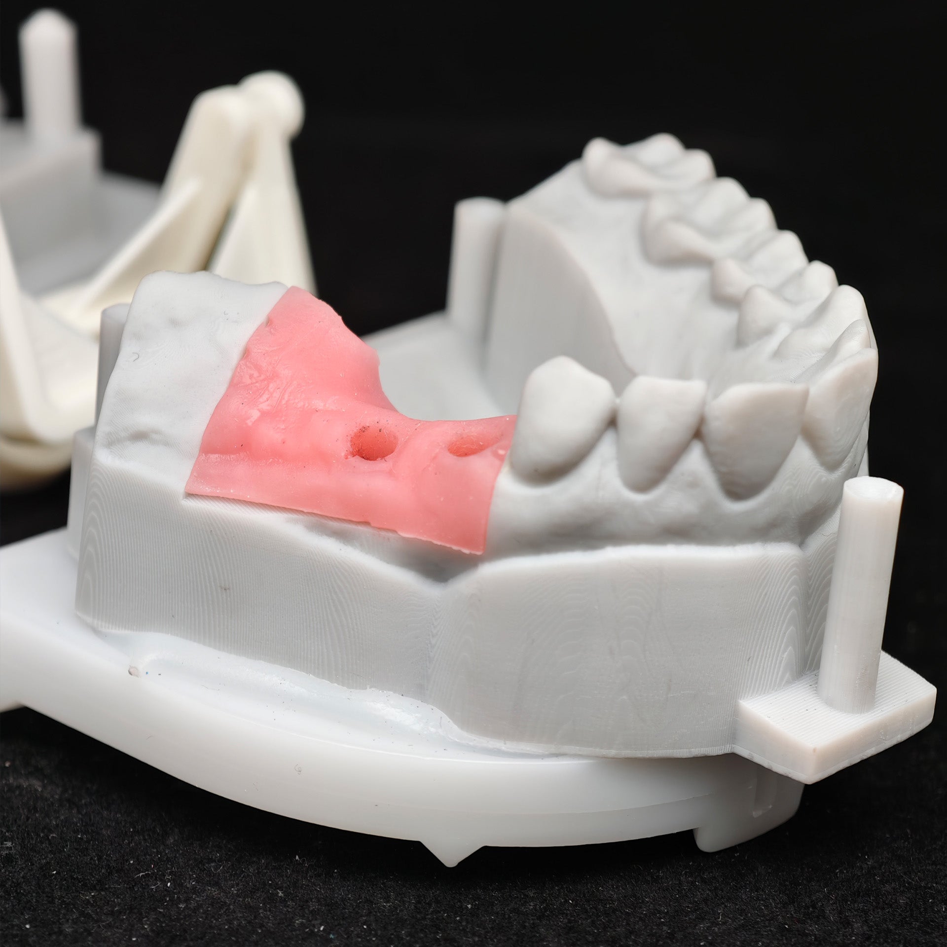 Zirconia Bridge With Screw Retained