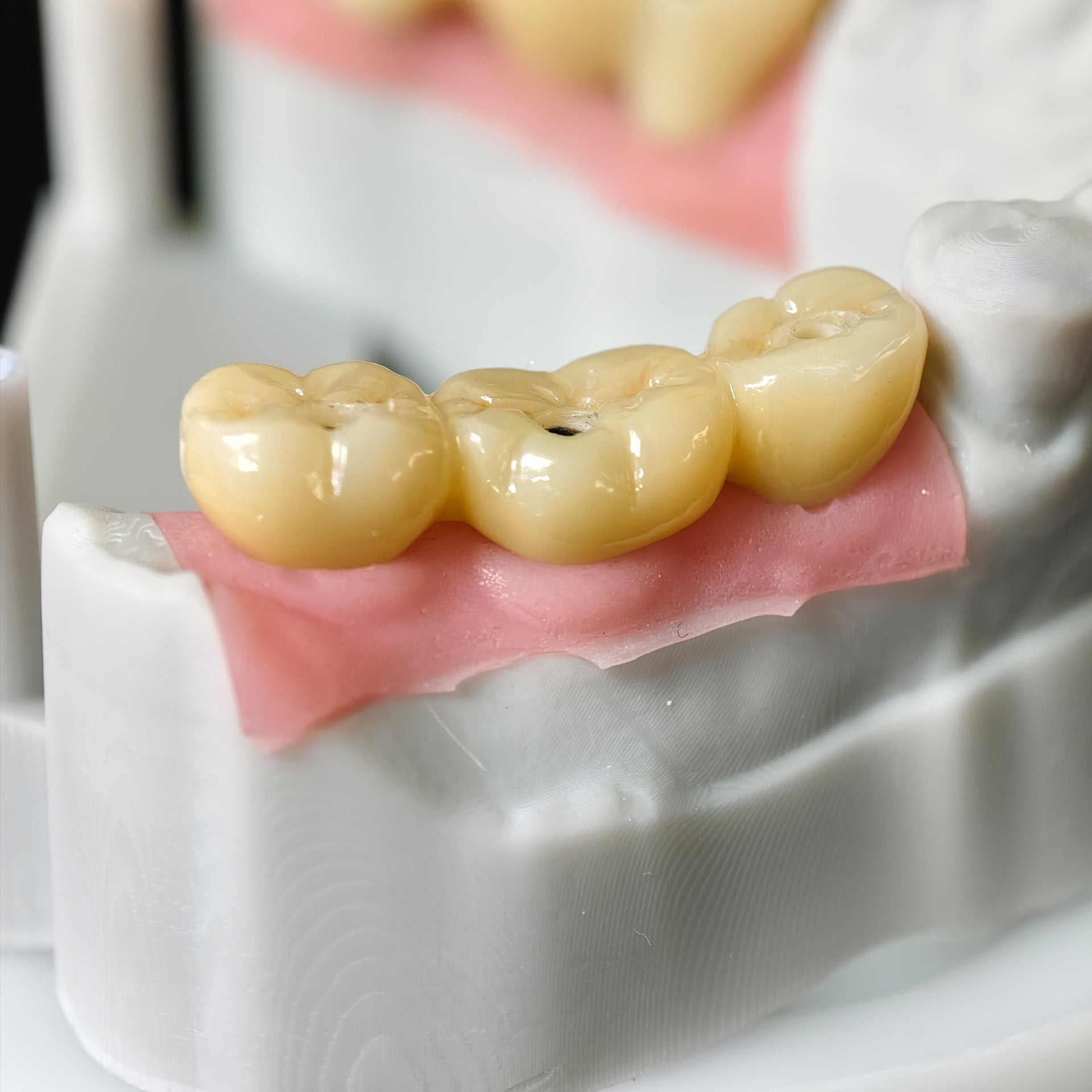 Zirconia Bridge With Screw Retained Gold Plating