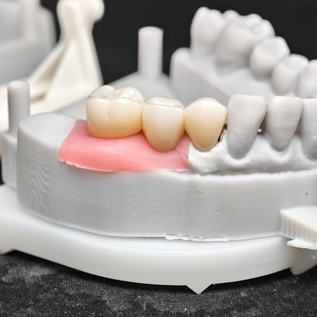 Zirconia Crown And Bridge With Screw Retained