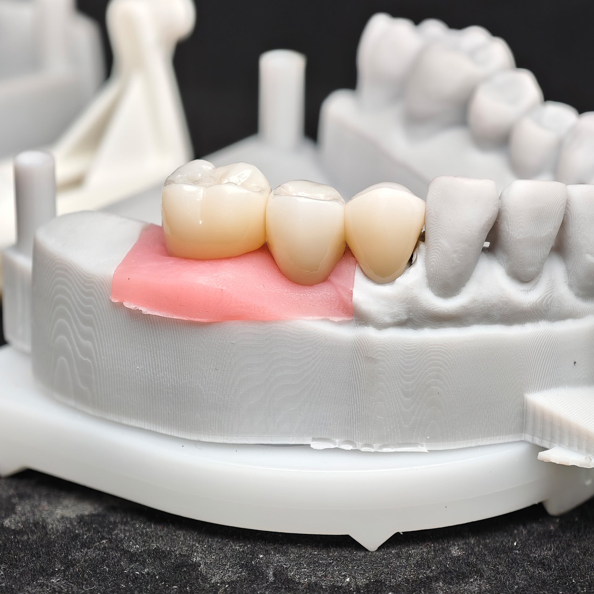 Zirconia Crown And Bridge With Screw Retained