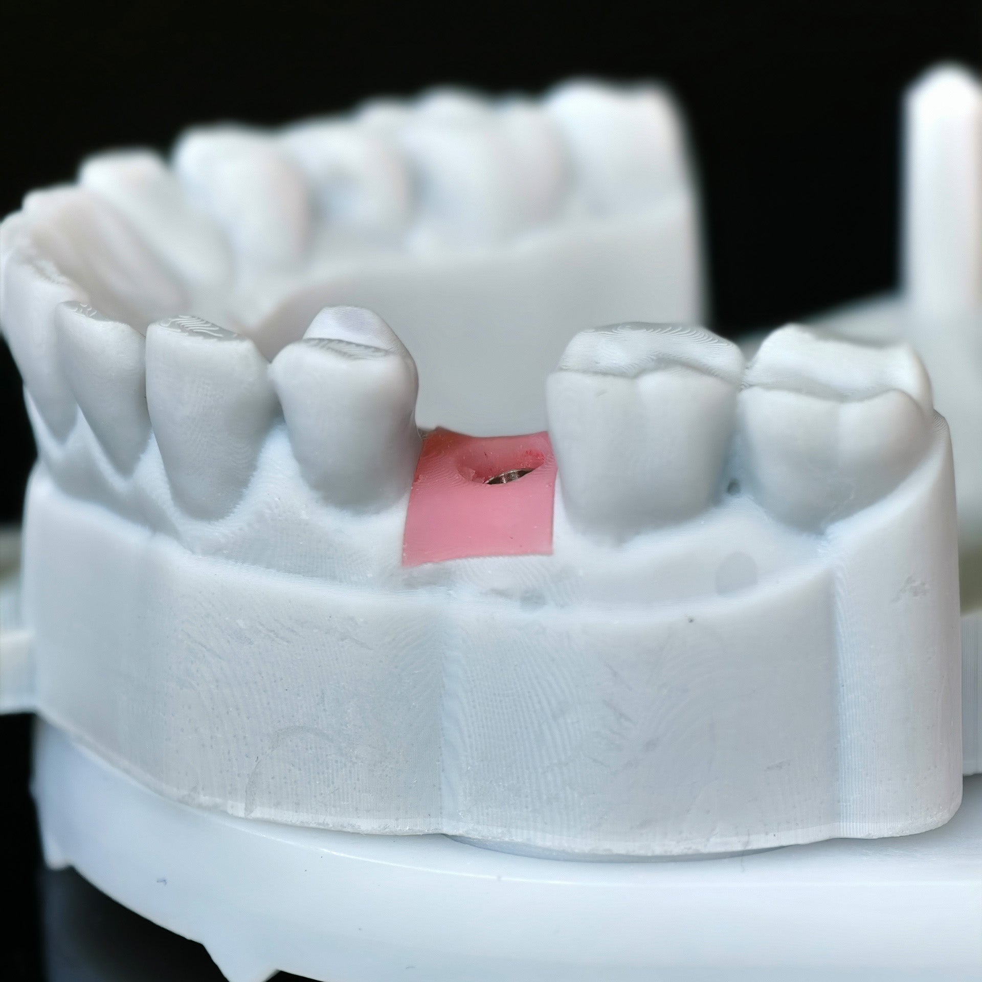 Zirconia Crowns With Screw Retained