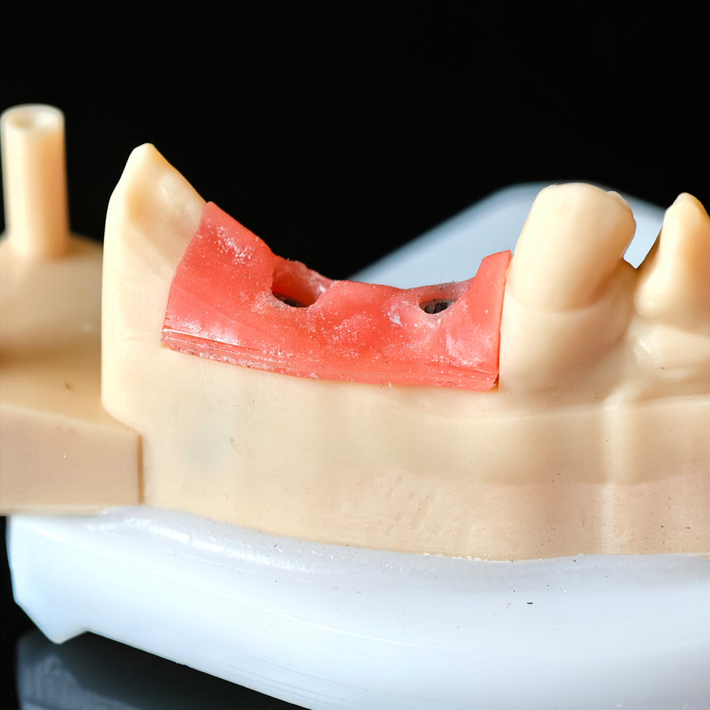 Zirconia Crowns With Screw Retained