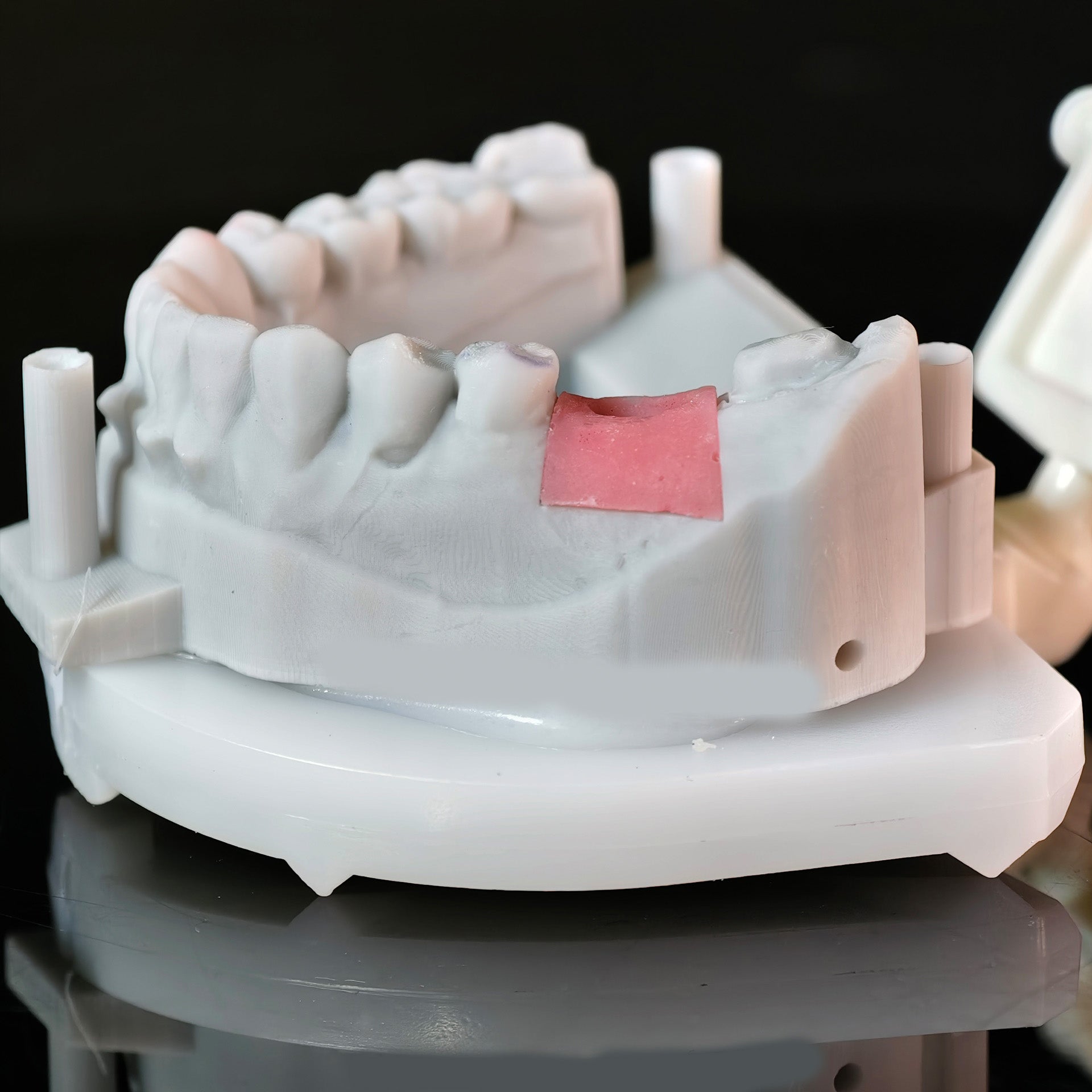Zirconia Crowns With Screw Retained And Cement Retained