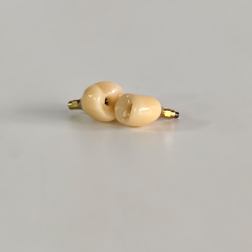 Zirconia Crowns With Screw Retained And Gold-Plated Custom Abutment