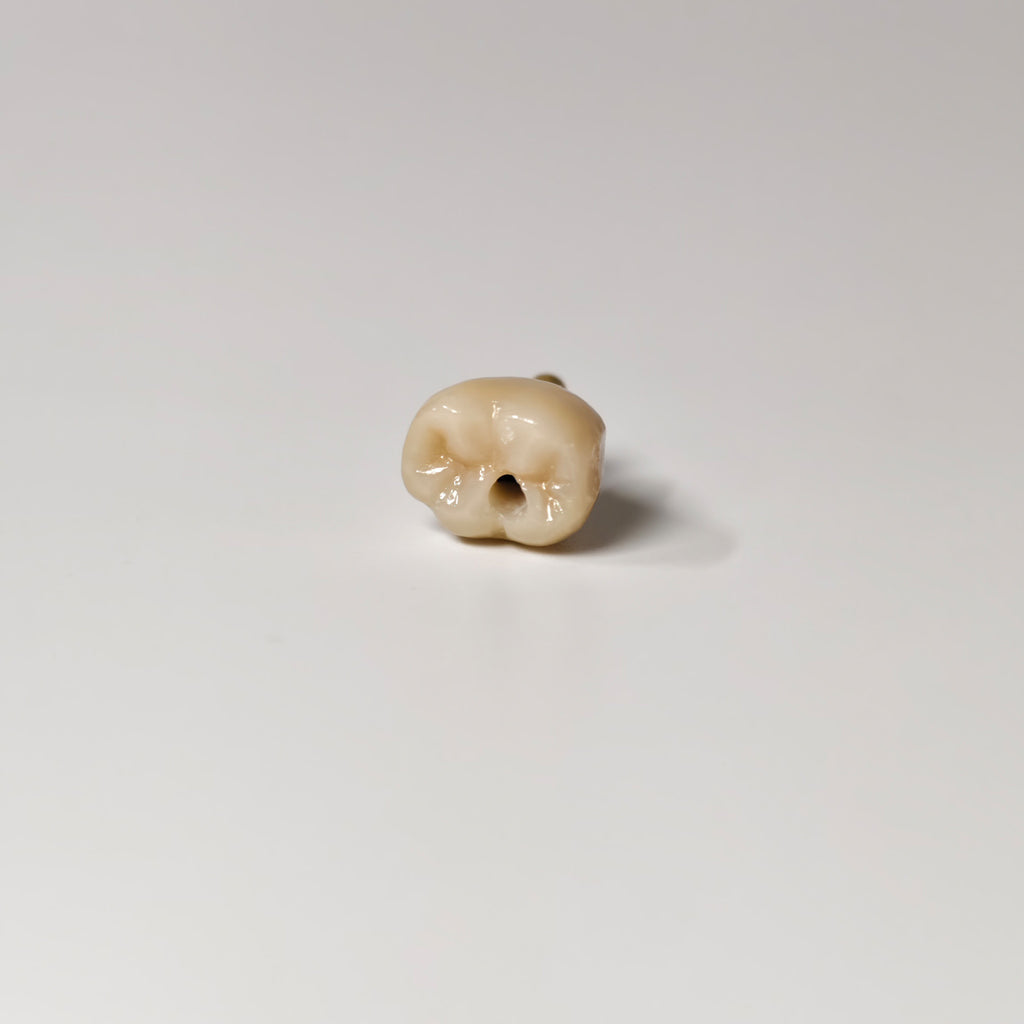 Zirconia Crown With Gold-Plated Abutment