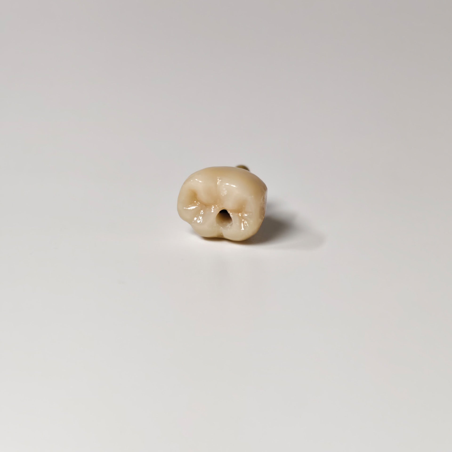 Zirconia Crown With Gold-Plated Abutment