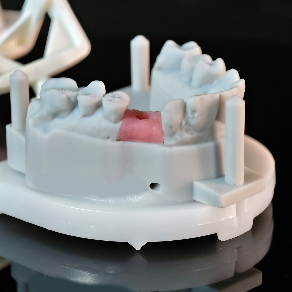 Zirconia Crown With Screw Retained