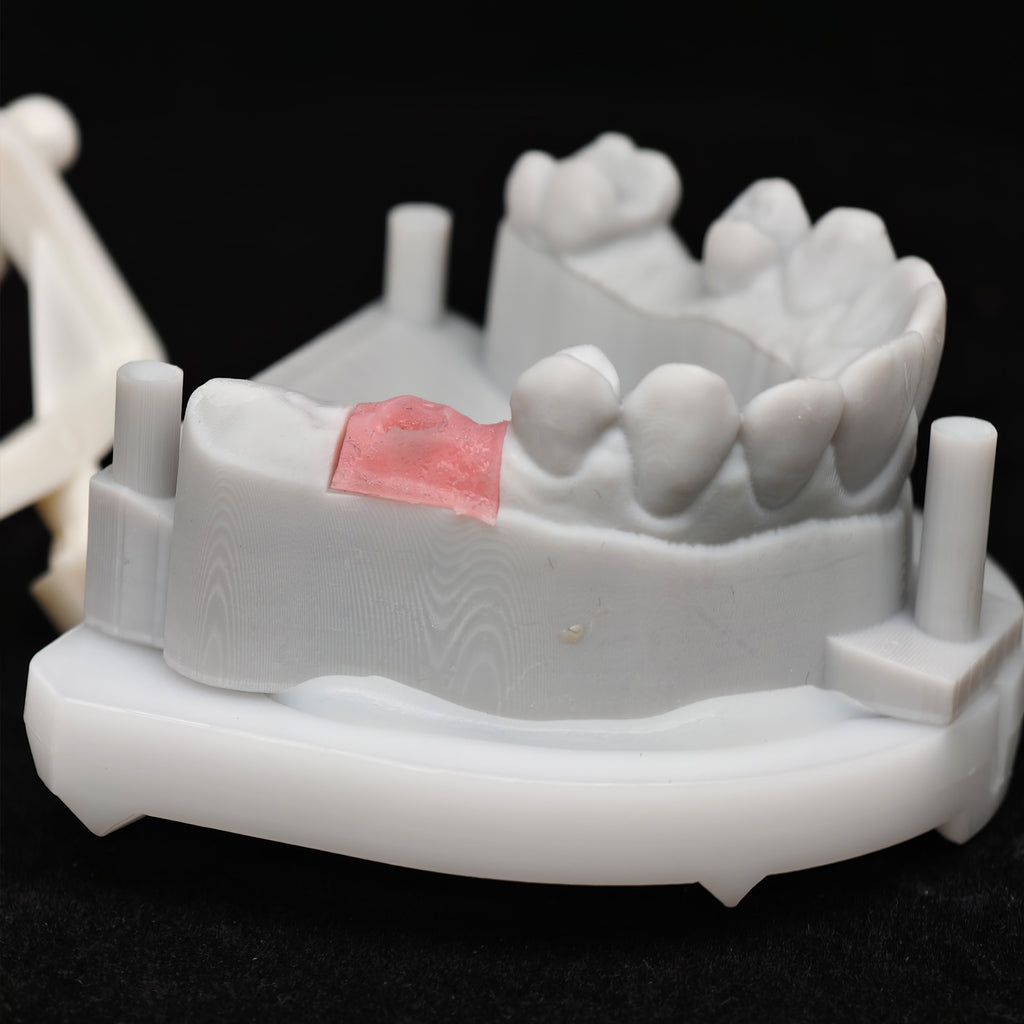Zirconia Crown With Screw Retained