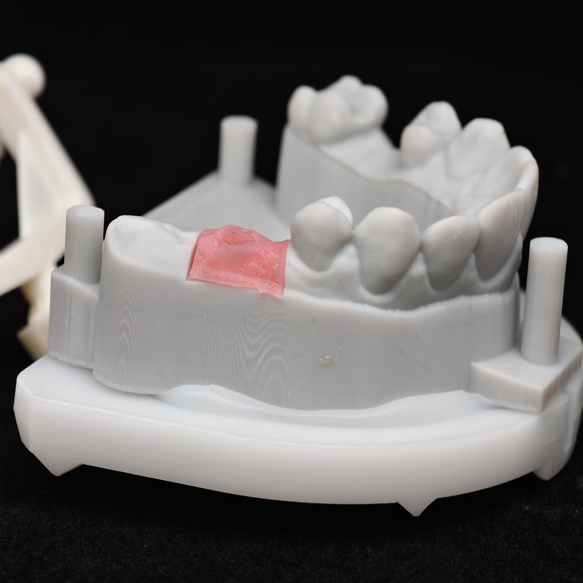 Zirconia Crown With Screw Retained