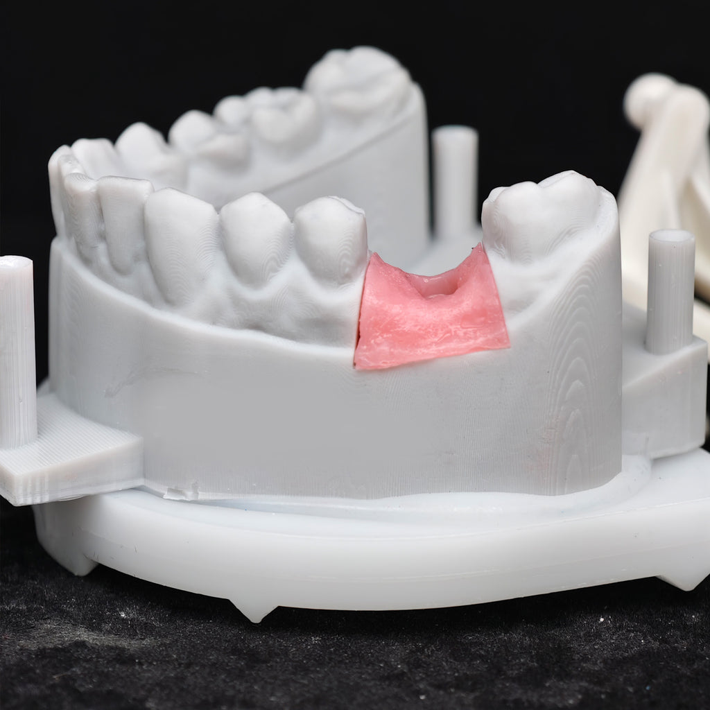Zirconia Crown With Screw Retained