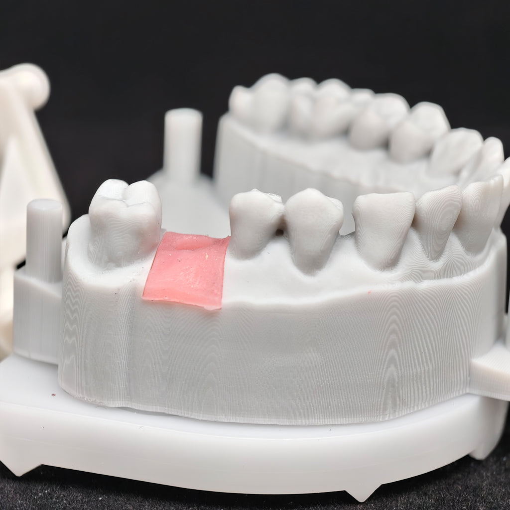 Zirconia Crown With Screw Retained