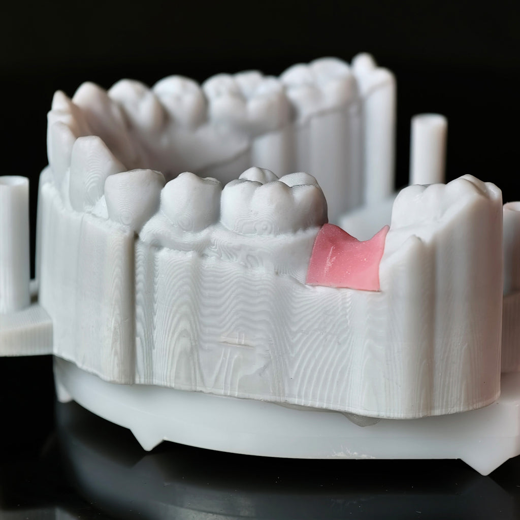 Zirconia Crown With Screw Retained