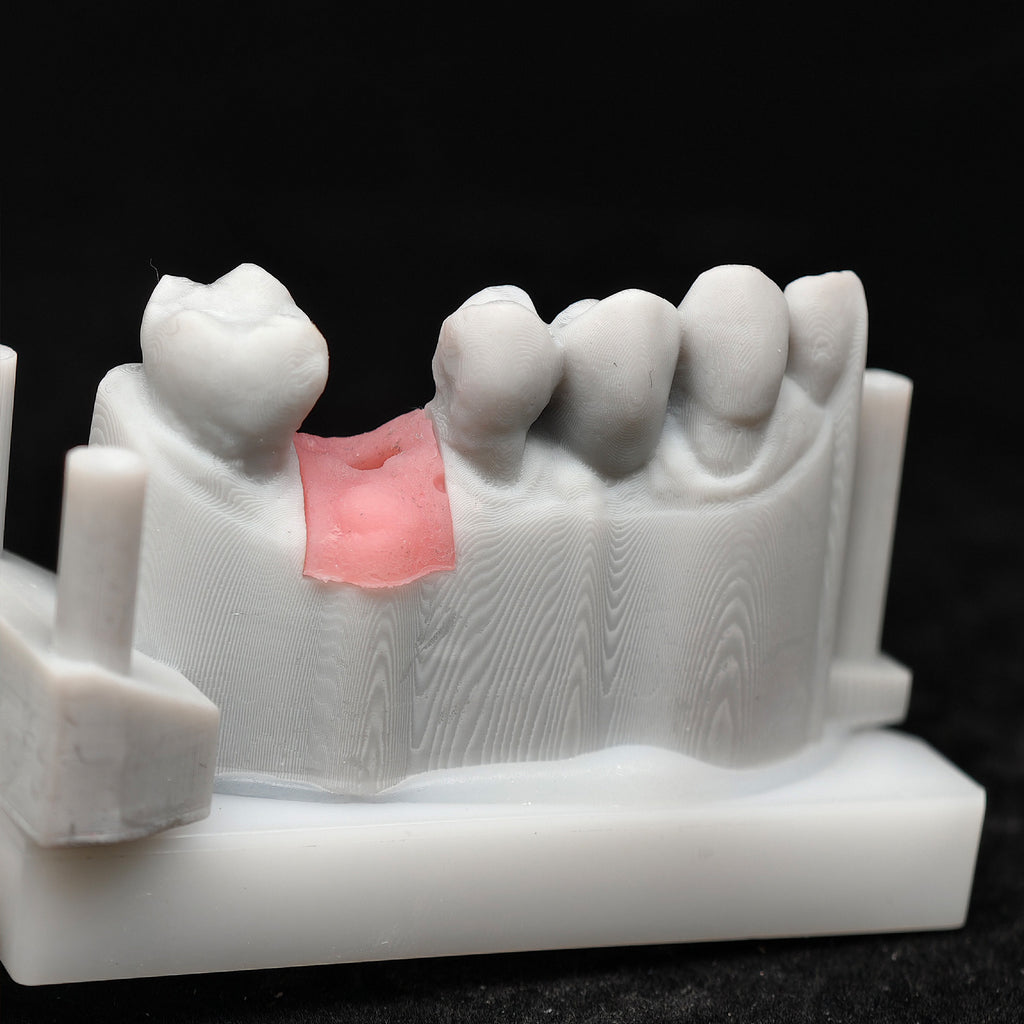 Zirconia Crown With Screw Retained