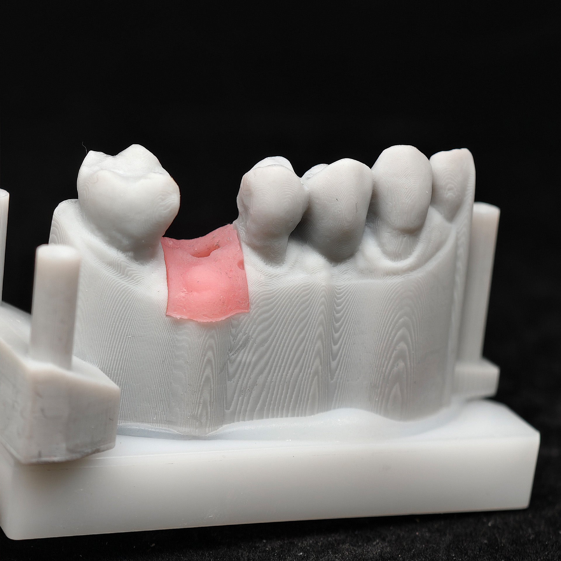 Zirconia Crown With Screw Retained