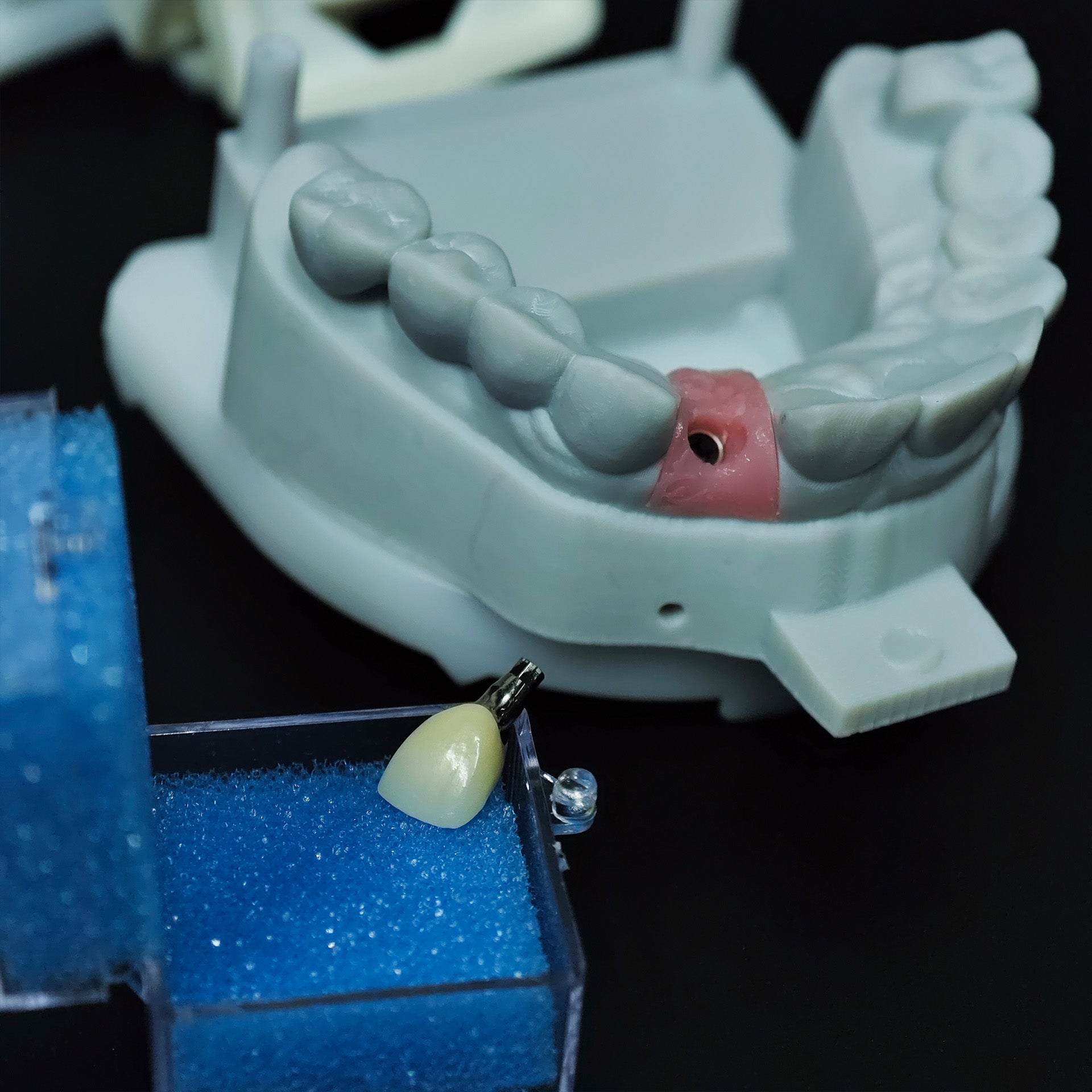Zirconia Crown With Screw Retained