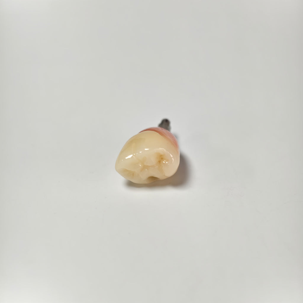 Zirconia Crown With Screw Retained