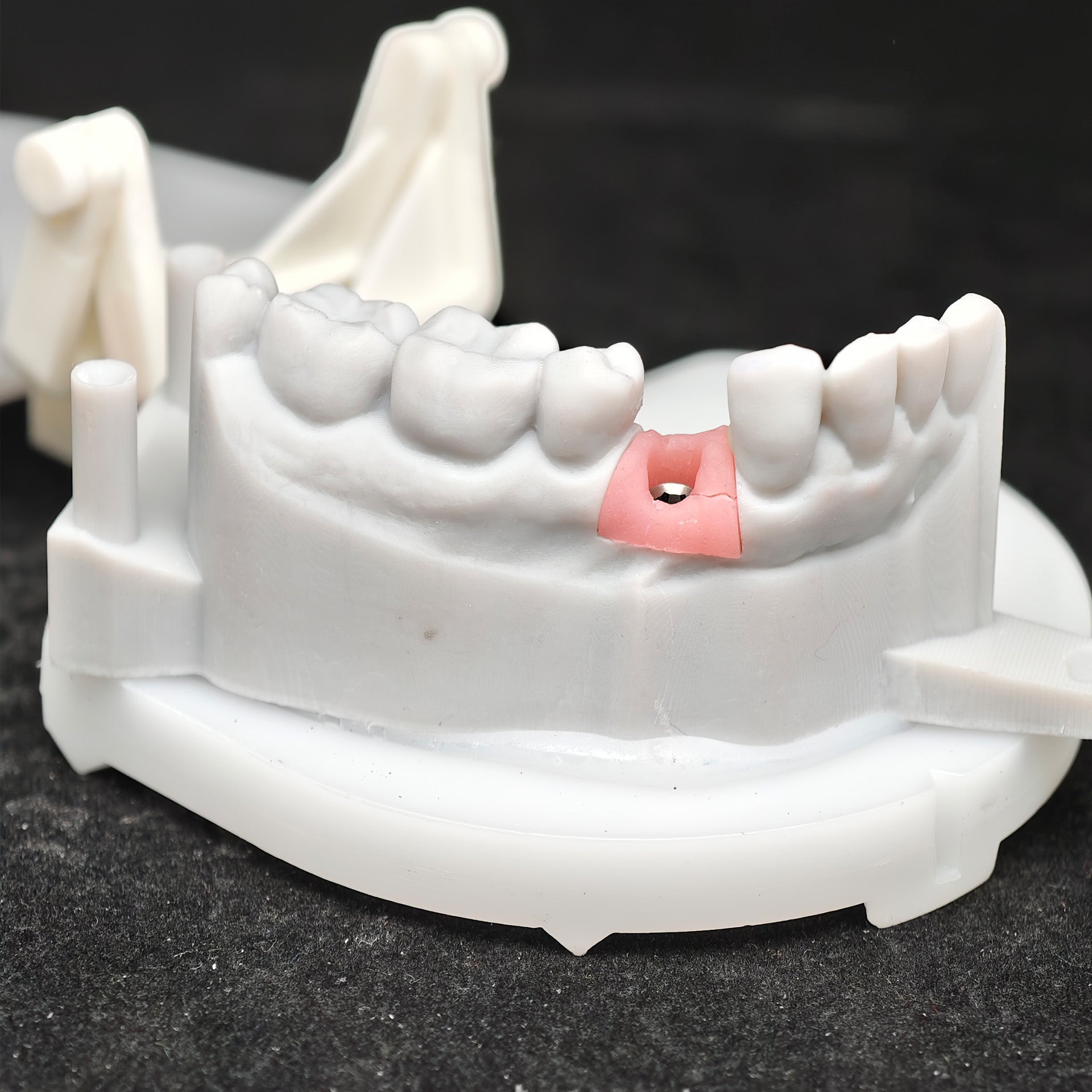Zirconia Crown With Screw Retained