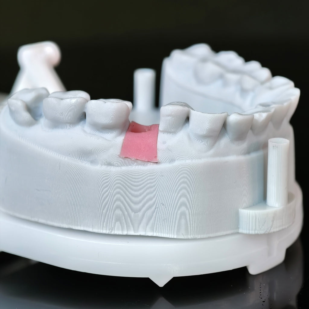 Zirconia Crown With Screw Retained