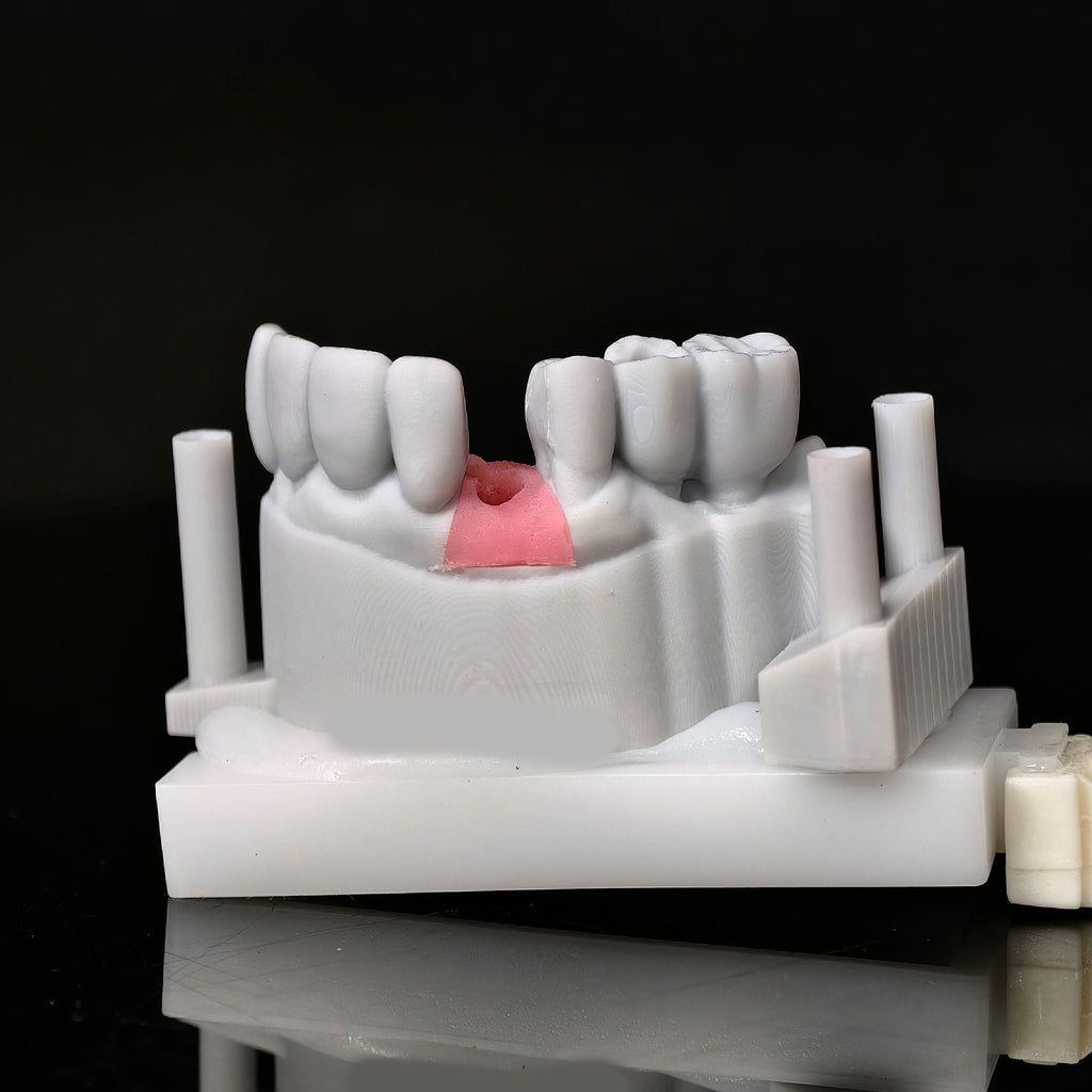 Zirconia Crown With Screw Retained