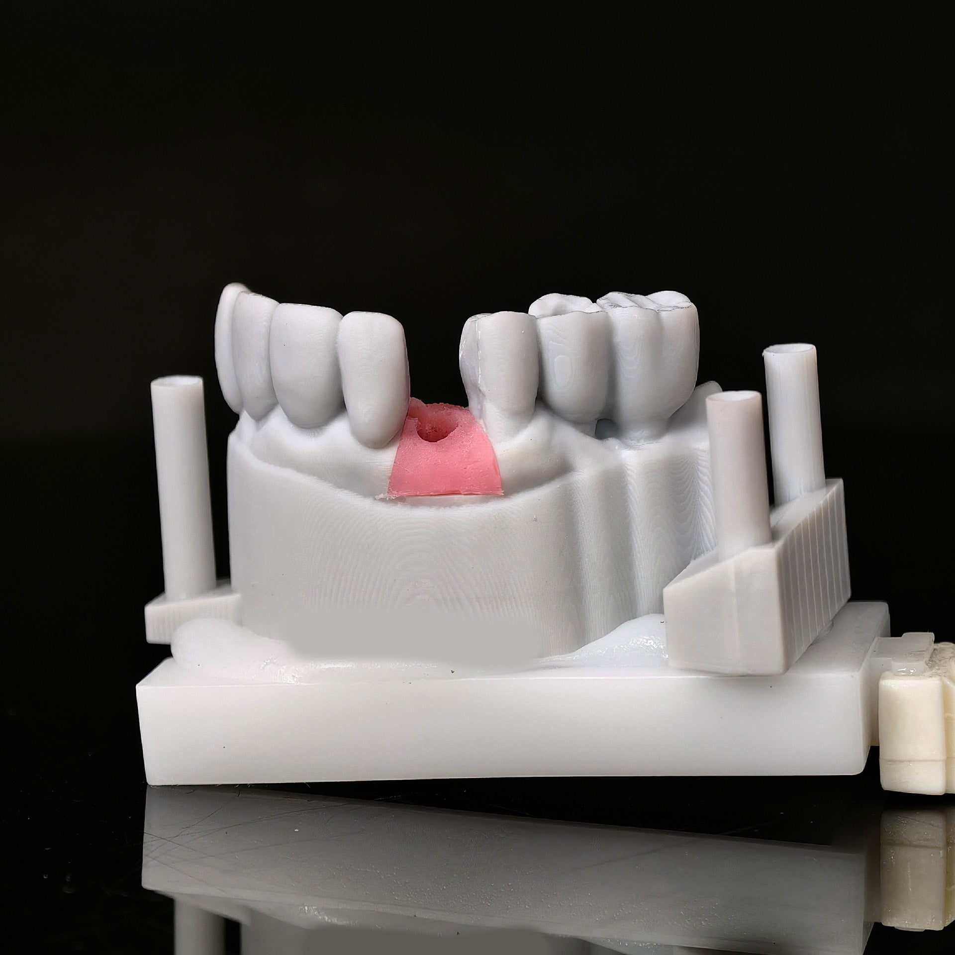 Zirconia Crown With Screw Retained