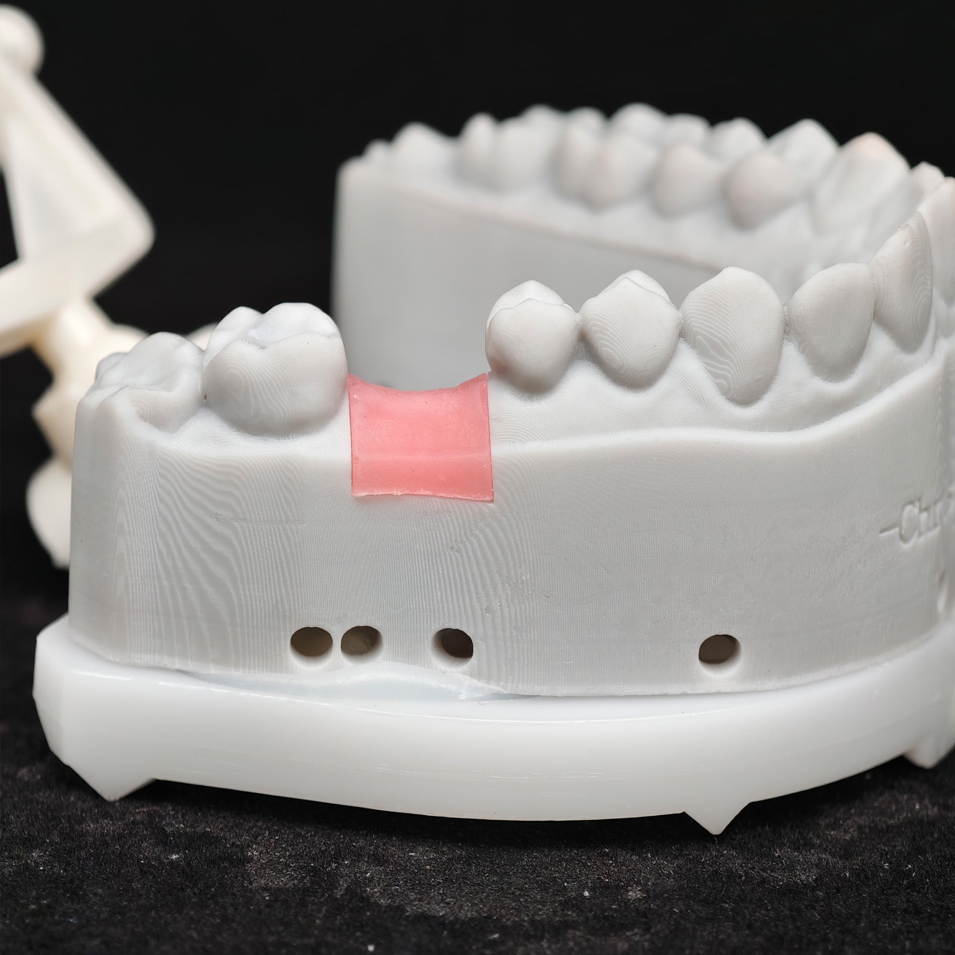 Zirconia Crown With Screw Retained