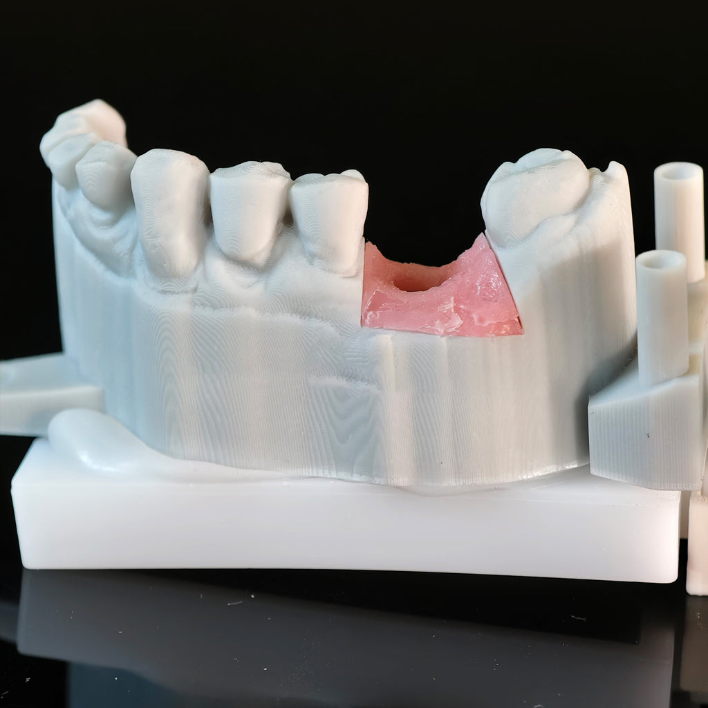 Zirconia Crown With Screw Retained