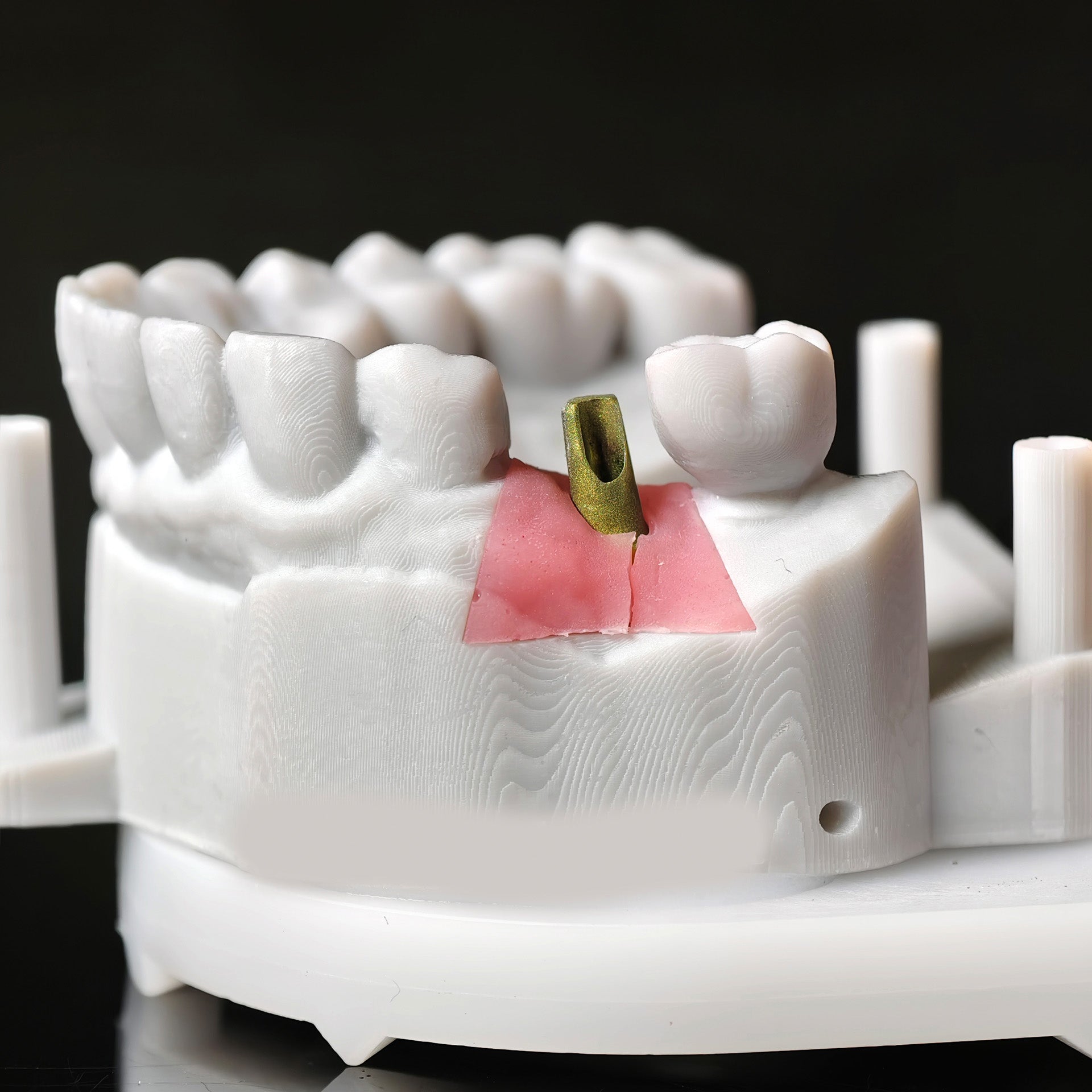 Zirconia Implant Crown Screwmentable Dental Crown