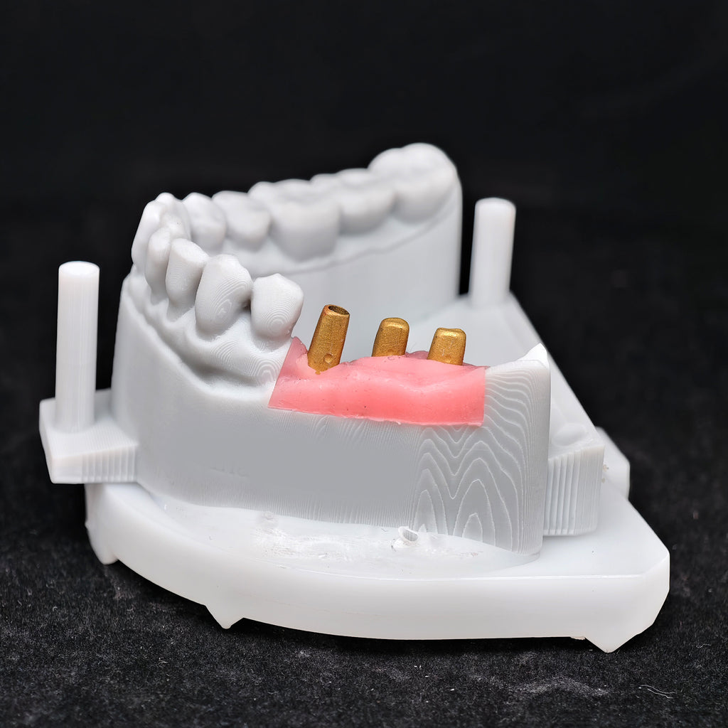 Zirconia Implant Crown Screwmentable Dental Crown