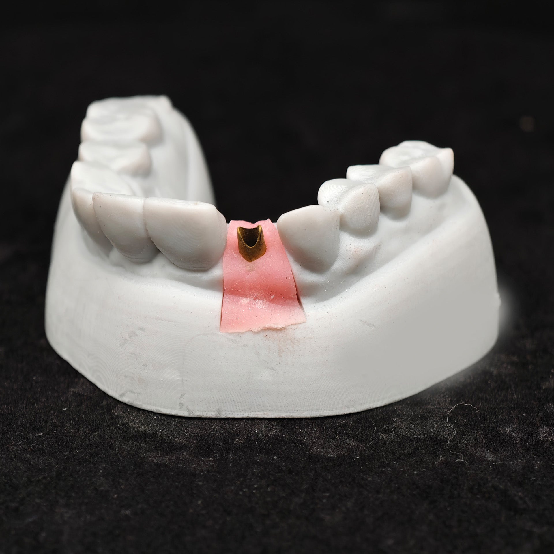 Zirconia Implant Crown Screwmentable Dental Crown