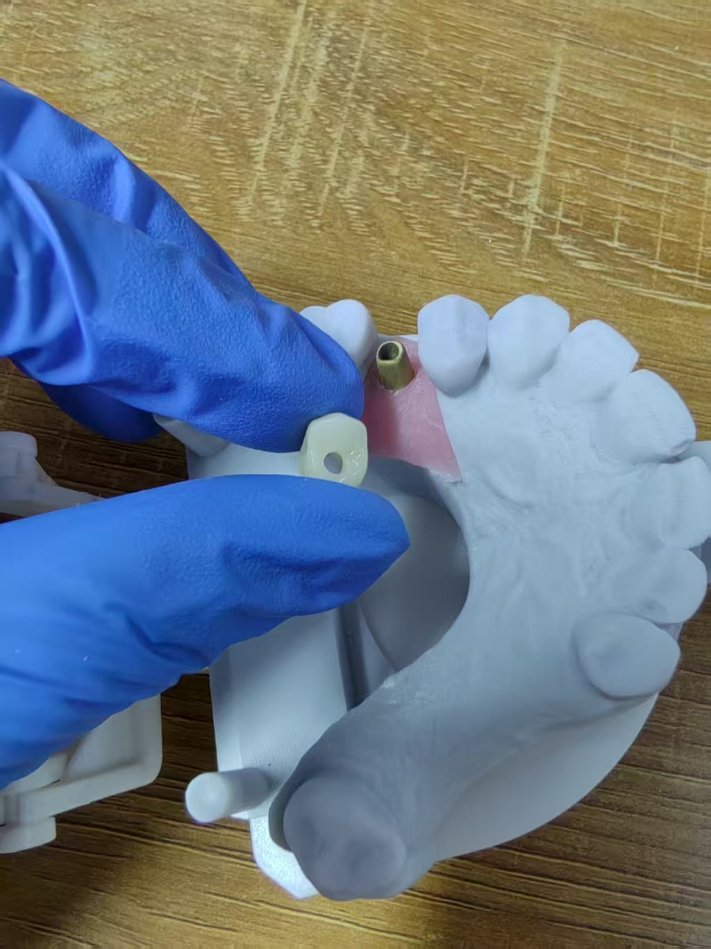 Zirconia Implant Crown Screwmentable Dental Crown