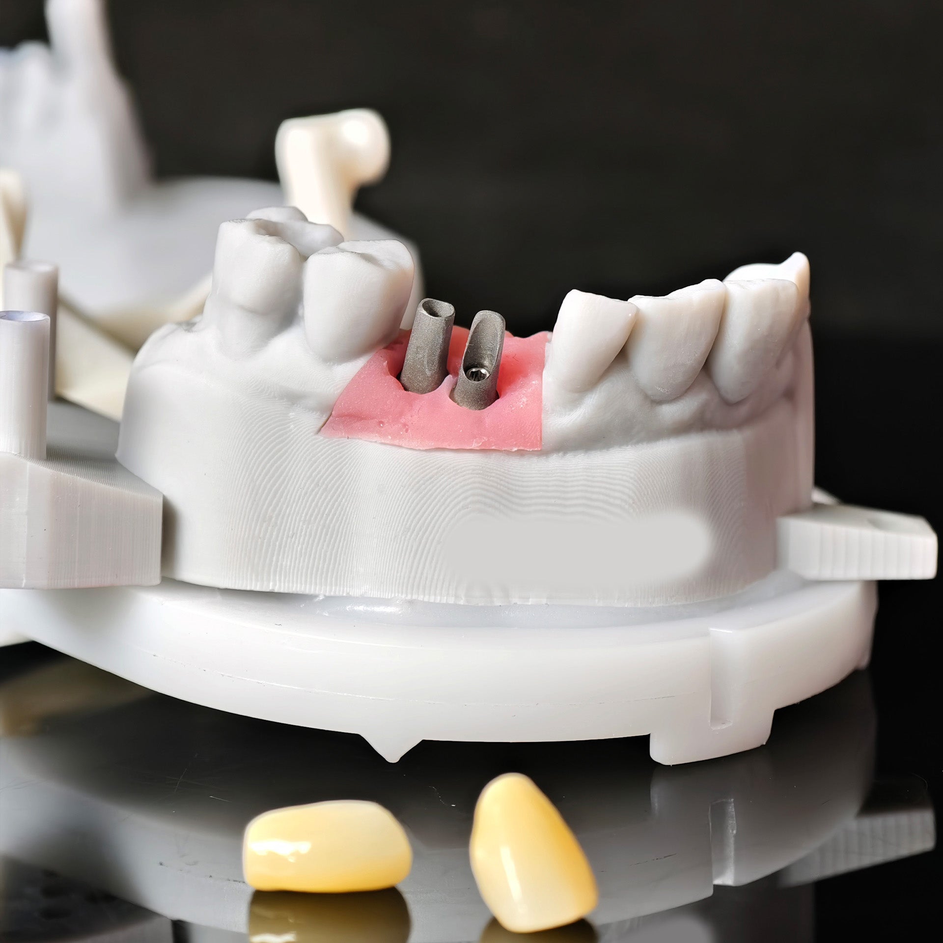 Zirconia Implant Crowns Screwmentable Dental Crown With Gold Plating