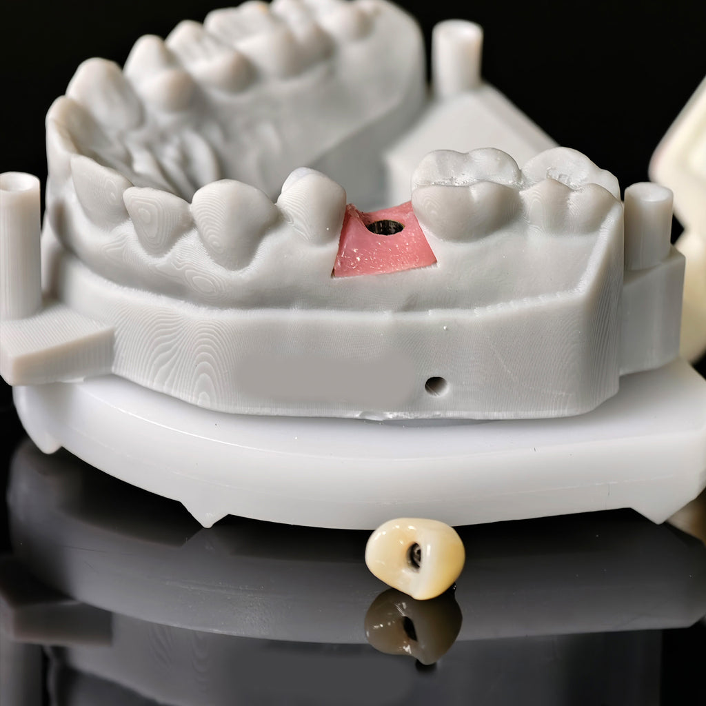 Zirconia Implant Crown With Gold Plating