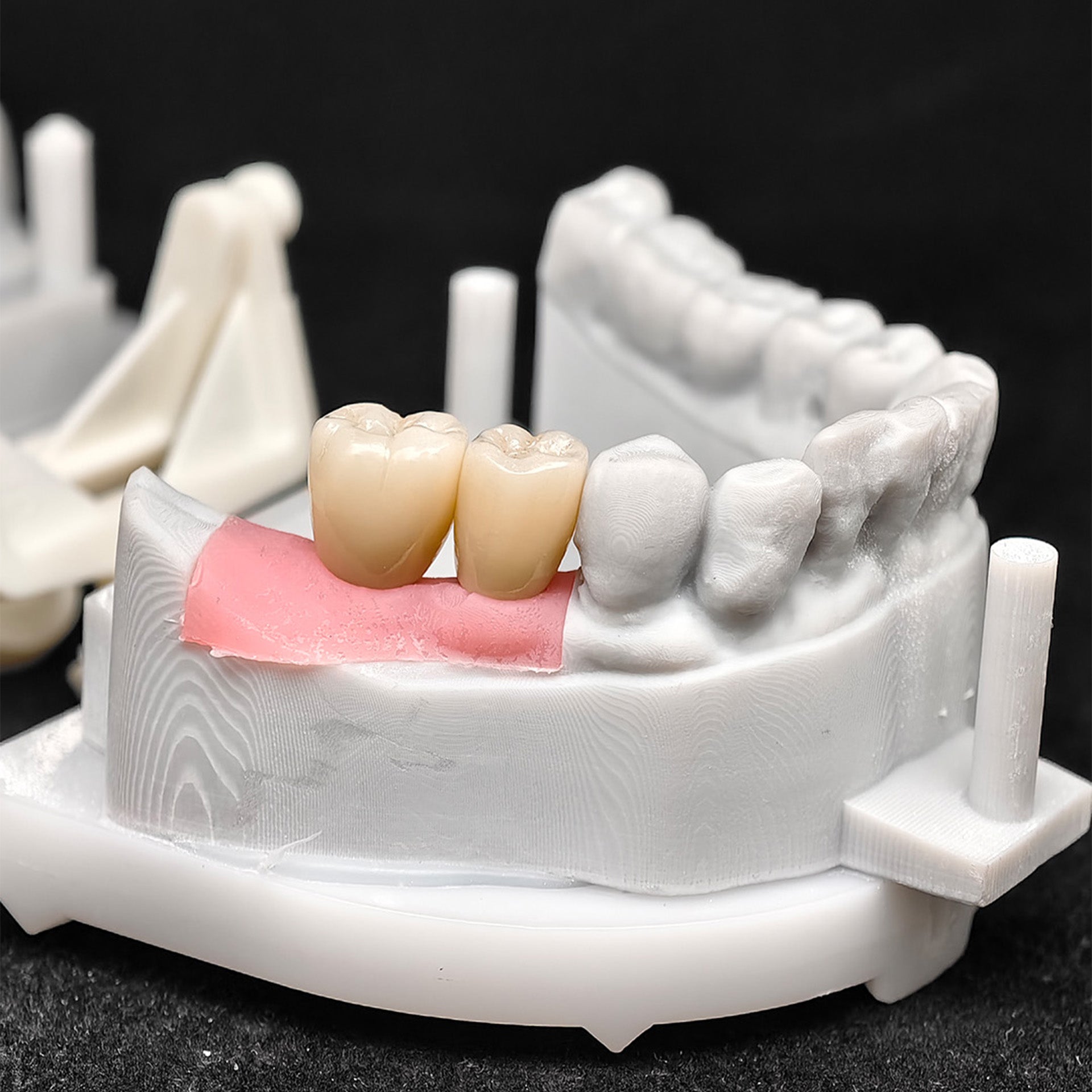 Custom Zirconia Implant Crowns