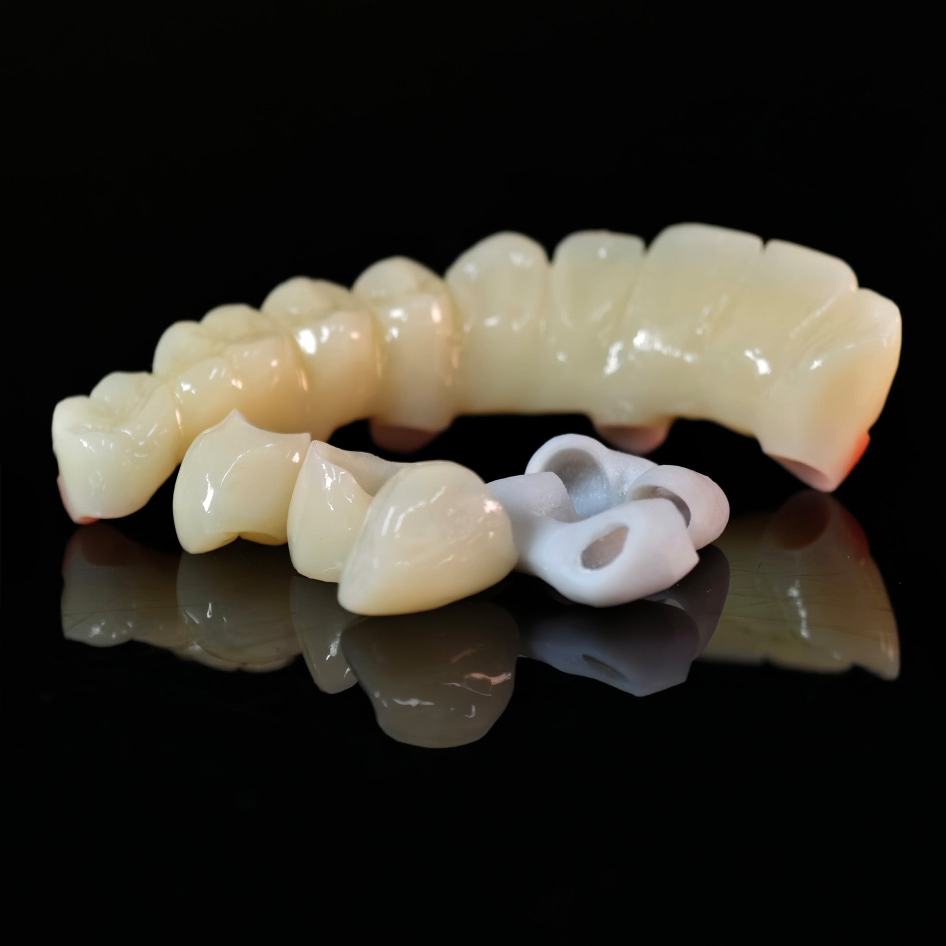 Custom Abutment And PMMA Bridge And Crown With Cement Retained