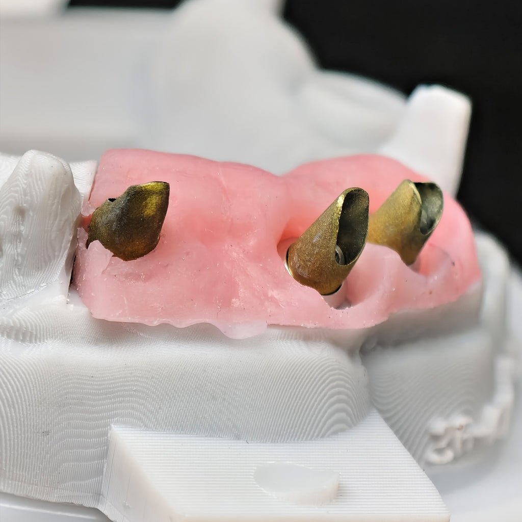 Custom Abutment With Zirconia Crown And Bridge