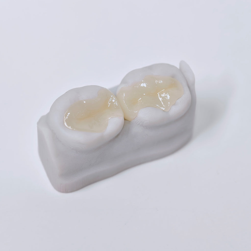 Full-Zirconia Laying With Cement-Retained