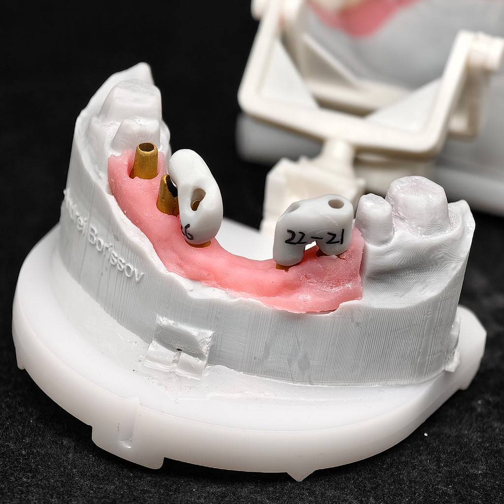 Pmma Bridge With Implant Seating Guide And Cemented
