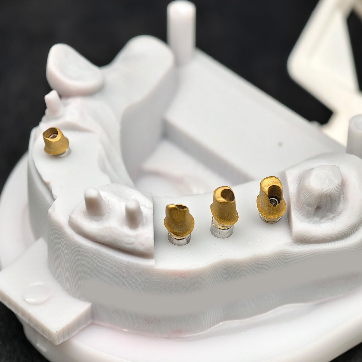 Zirconia Crown And Birdge With Cemented And Implant Seating Guide