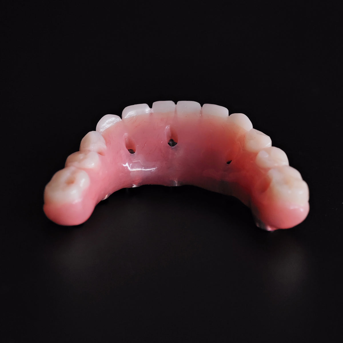 An Acrylic Denture With A Titanium Bar (Ti-Bar) Cost-Effective Full Arch Restoration Screw Retained