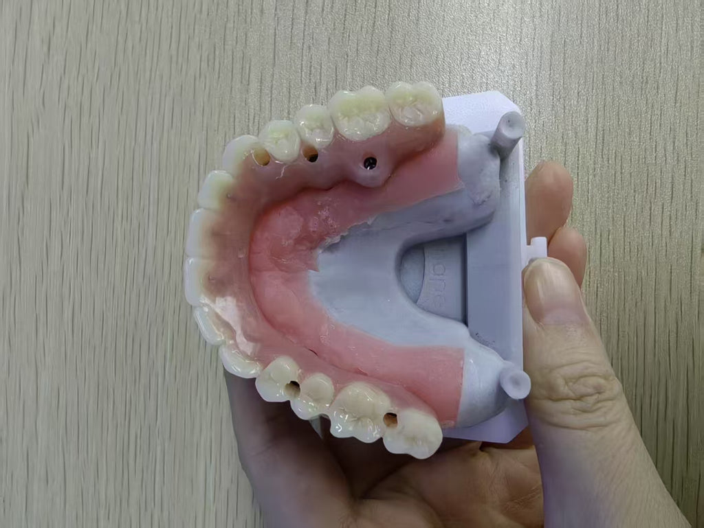 An Acrylic Denture With A Titanium Bar (Ti-Bar) Cost-Effective Full Arch Restoration Screw Retained