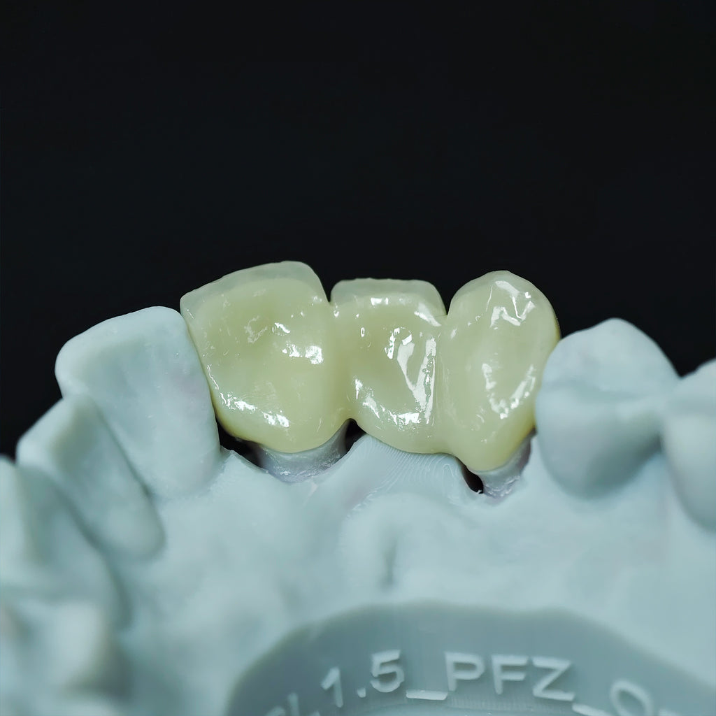 Beautiful Zirconia Bridge