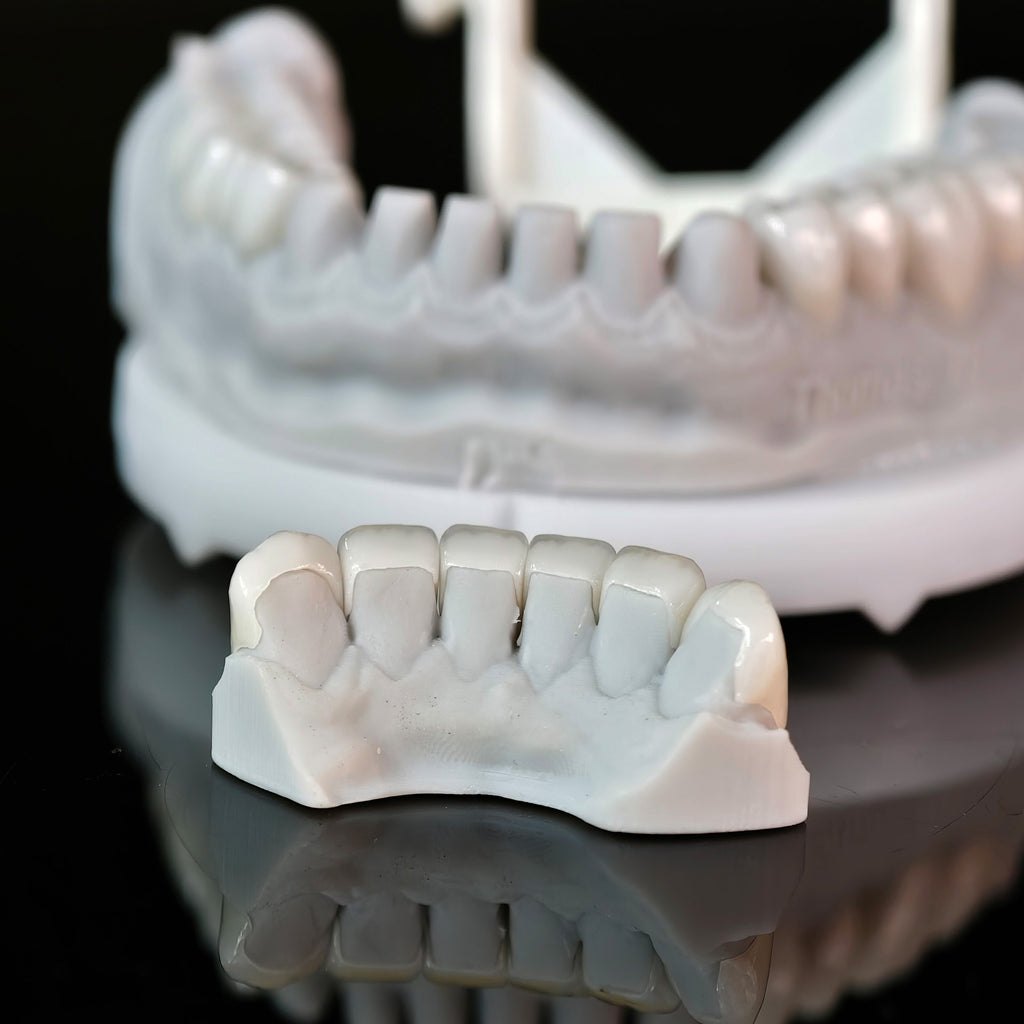 Ceramic Veneers And Crown With Cement Retained