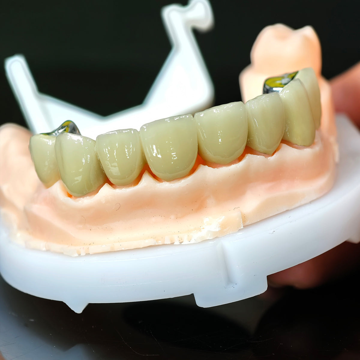 Co - Cr PFM Dental Bridge