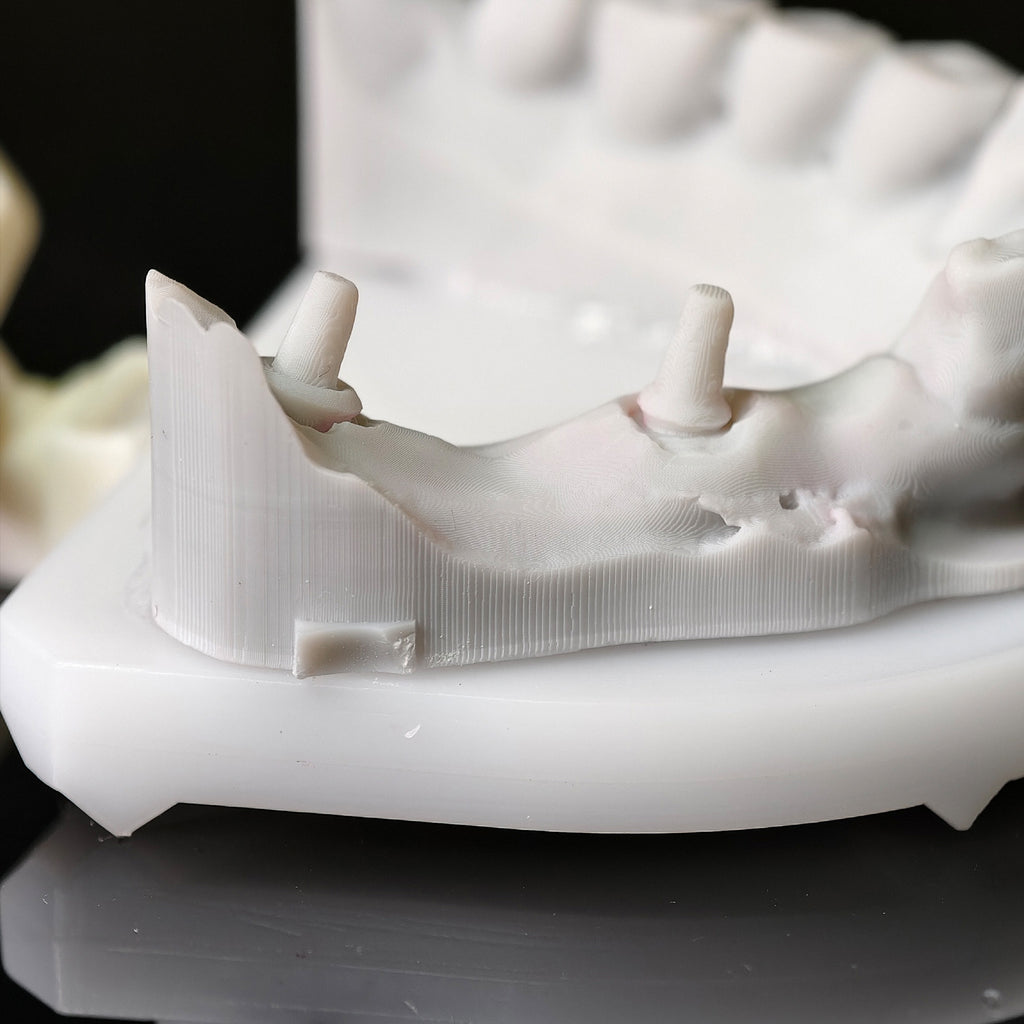 Co - Cr PFM Dental Bridge