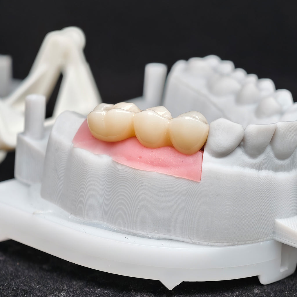 Custom Zirconia Implant Bridge
